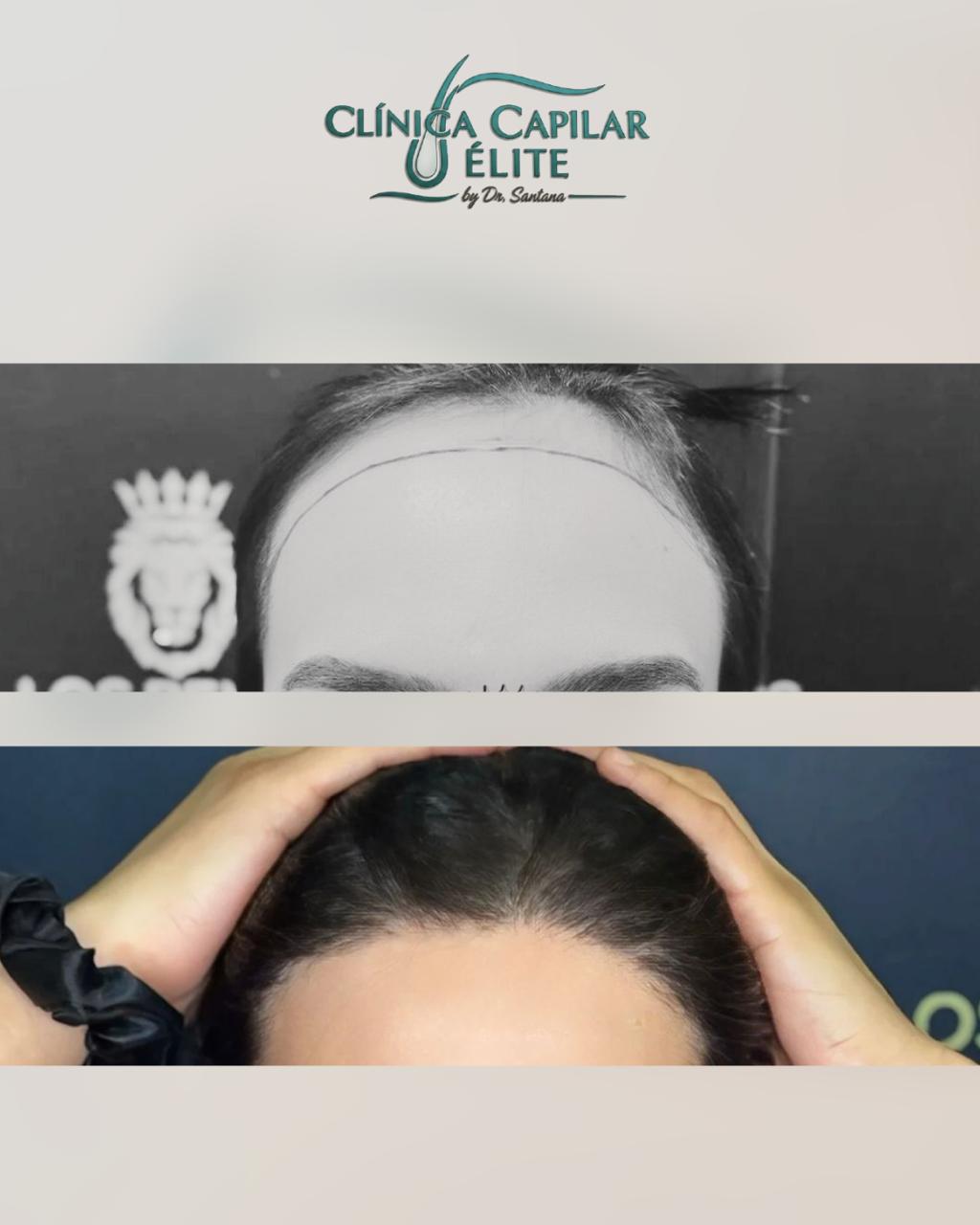 Caso complejo barba